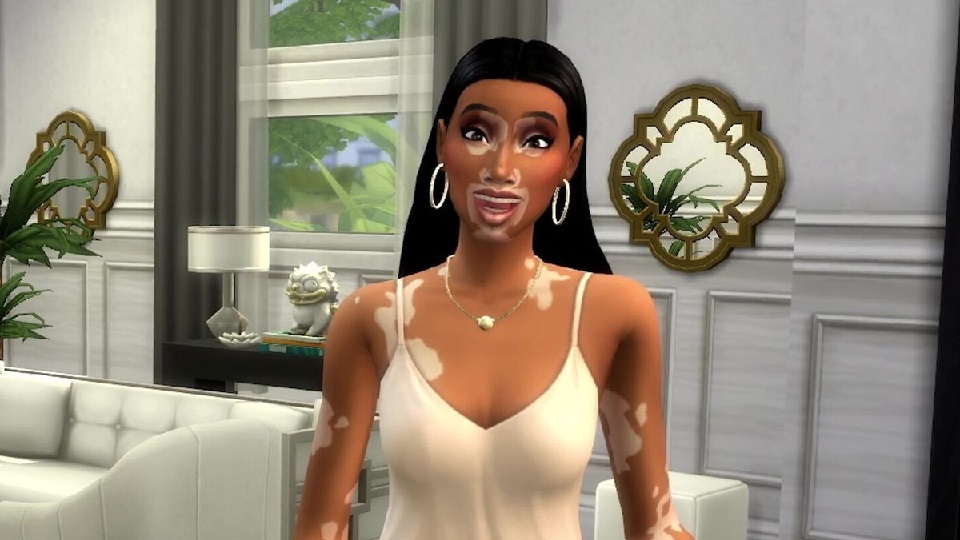 The Sims 4'e Gelen Güncelleme İle Oyuna Vitiligo Dış Görünümü Ekleniyor